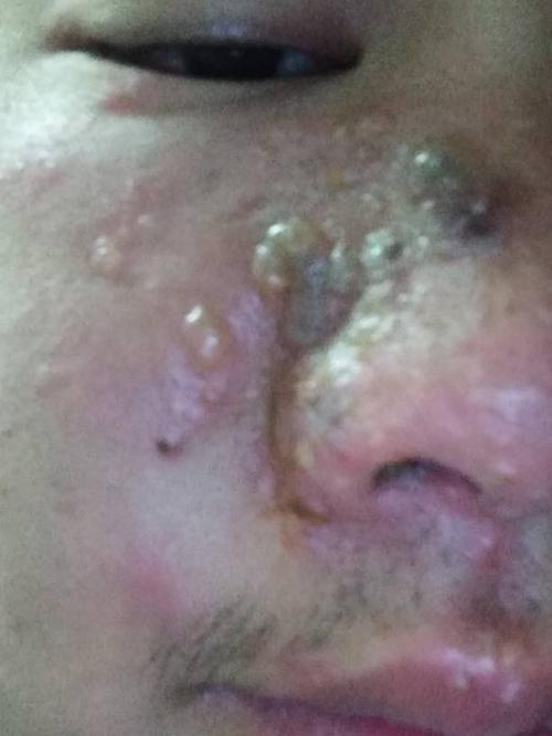 蛇胆疮怎么治疗脸上长蛇胆疮怎么治疗,好疼 答题抽奖 首次认真答题