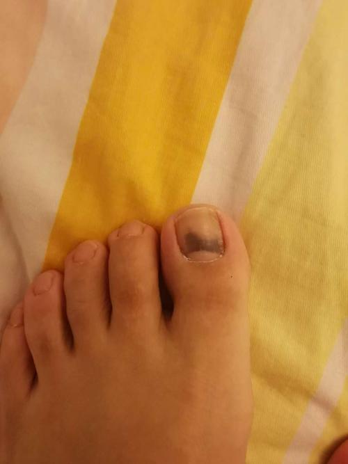 我有一天走路,回家发现脚的大拇指甲突然