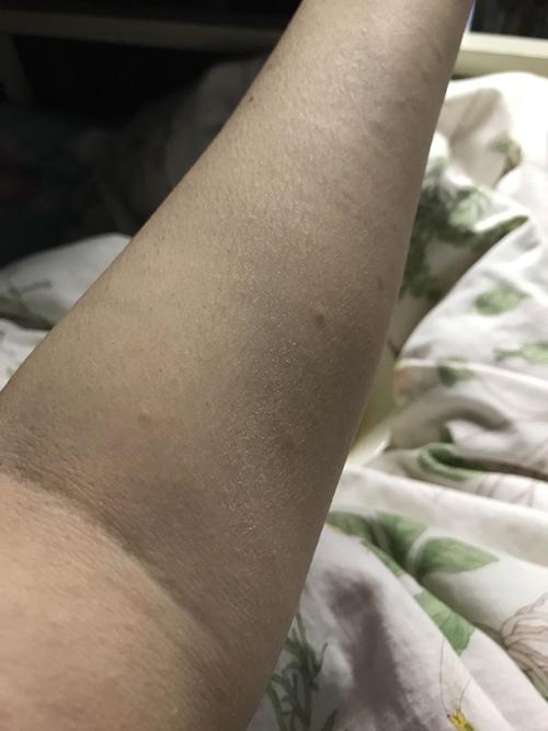 胳膊上突然长了白色的痘痘也不痒是怎么了?