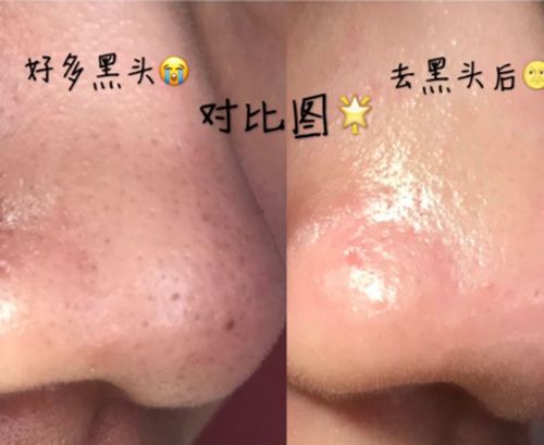 (去黑头前后对比图)
