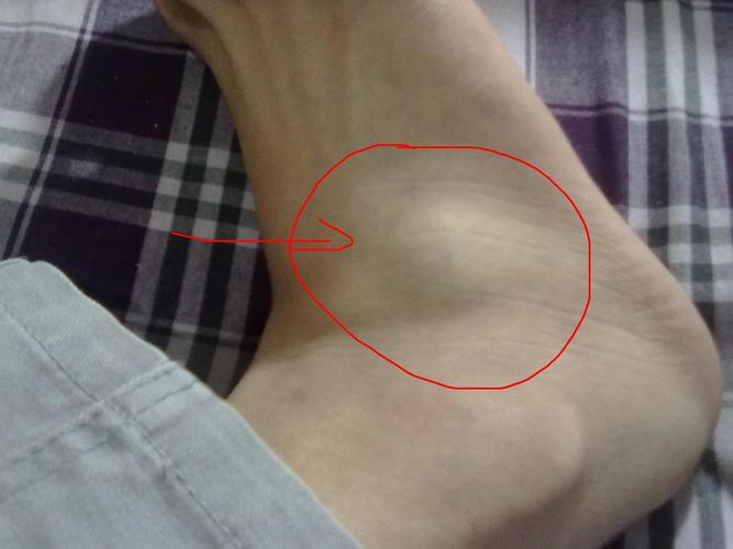 应该没事,先别怕 评论|  2014-02-14 23:09   热心网友  是 腱鞘囊肿