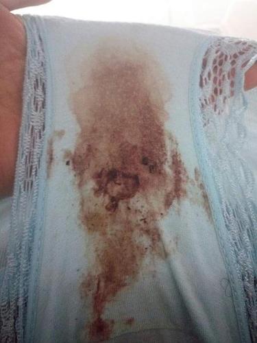 连续半个月白带带血,有时候头晕,有图,慎入