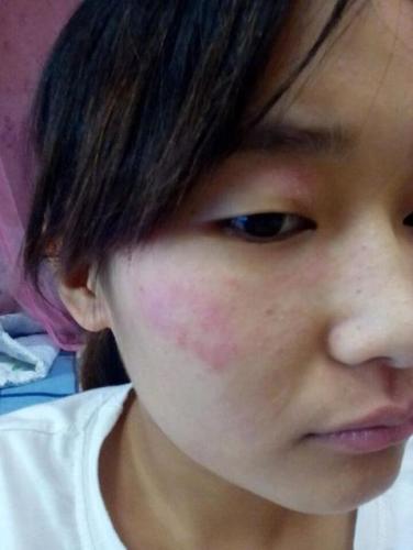 脸上出现红色一片片的还特别痒这是什么原因