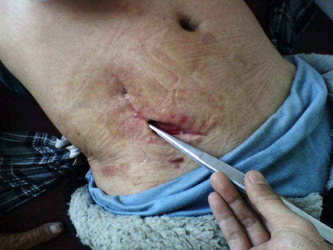 阑尾炎  皮肤  糖尿病