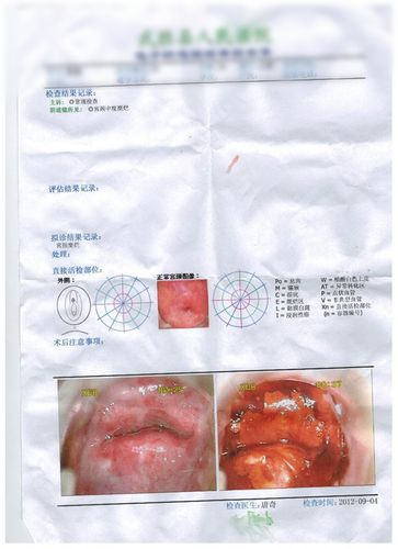 宫颈糜烂中度怎么办?