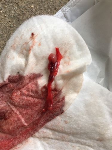 请问这是孕囊吗?