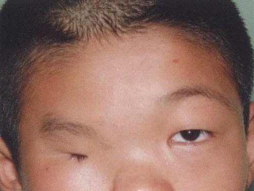 典型病例:z成形术矫正先天性眉不对称畸形