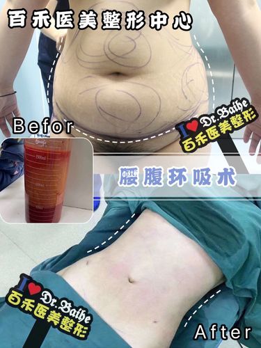 腰腹环吸. 术后立刻对比_腰腹_减肥_减肥医药