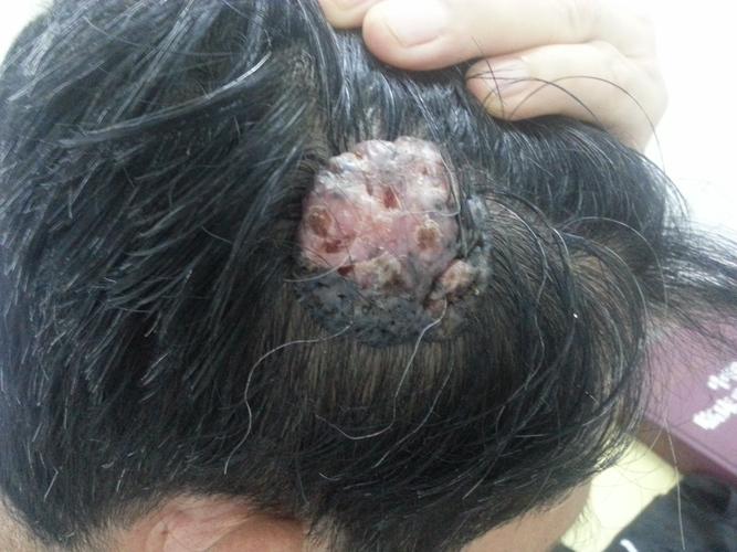 头皮肿物10年,无溃烂
