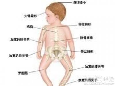 佝偻病病因的介绍