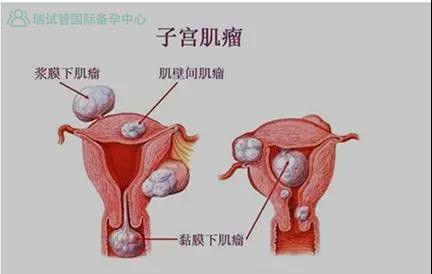 备孕中查出子宫肌瘤,我还能怀孕吗?