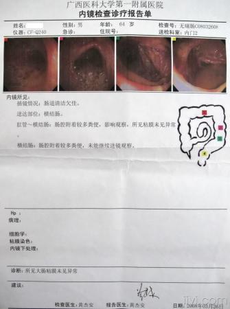 这个病例可以诊断为肝硬化(失代偿期)吗?