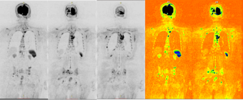 航天院区病例 类pet 前列腺癌骨转移情况