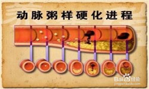 高脂饮食与动脉粥样硬化