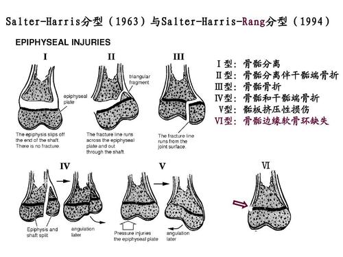 儿童骨骺损伤影像诊断(急)