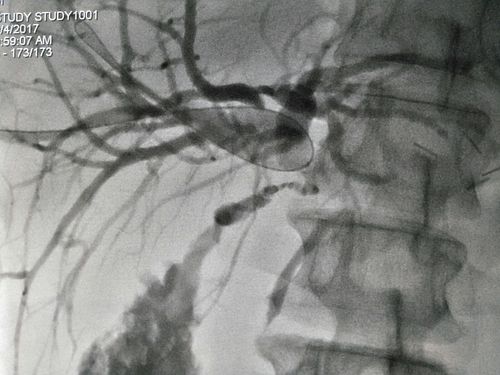 ptcd:胰腺癌术后胆总管梗阻支架置入术 胆道引流术
