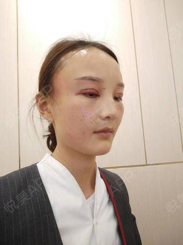 2天_开眼角术后2天_双眼皮术后2天_眼部术后2天_最可爱星星分享图片4