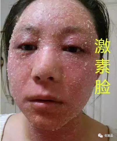过敏性皮炎激素脸