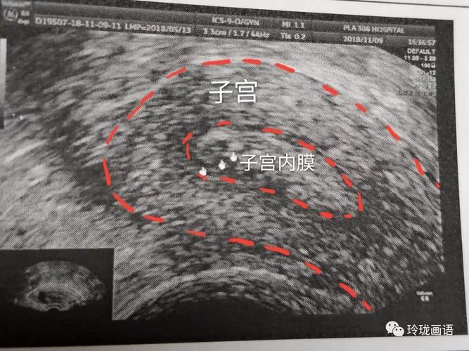 教你看懂妇科b超报告超级干货来啦