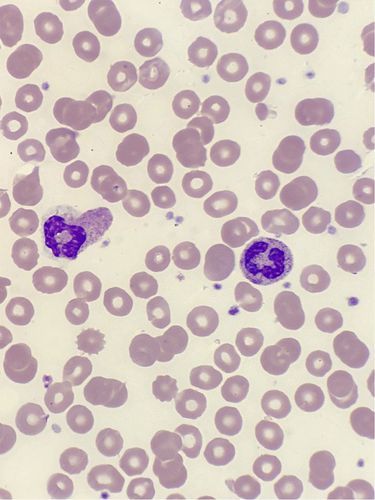 偶遇一例川崎病血涂片带来的思考|粒细胞|白细胞