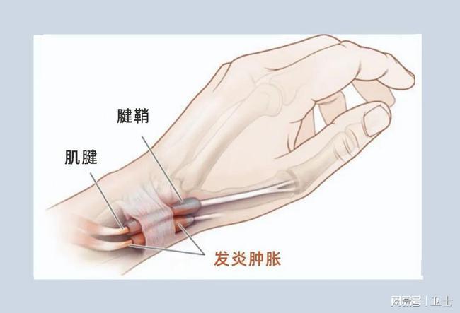 手部不同位置的疼痛预示不同的问题赶紧自查