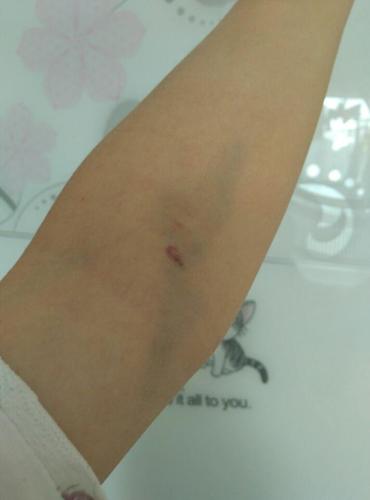 周五抽血,到现在还有块变大的紫色块块和10多cm的青块,要紧吗?