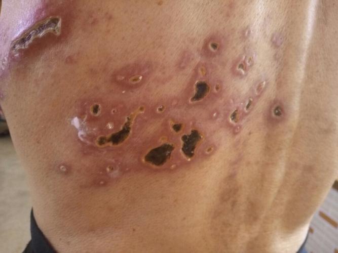 蛇盘疮长成这样是要痊愈了还是恶化了,原来的水泡瘪了