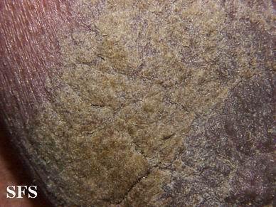 结痂性疥疮(norwegian scabies)07