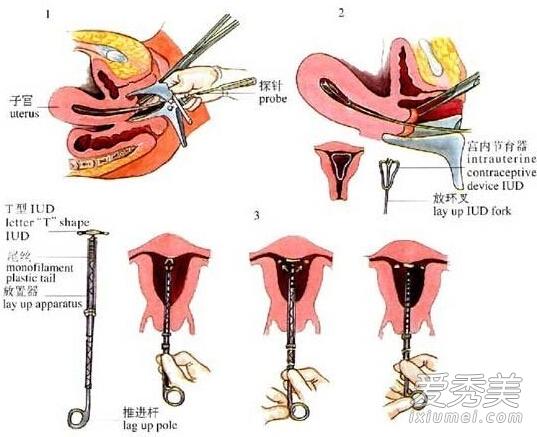 (组图)揭秘女性上环避孕全过程