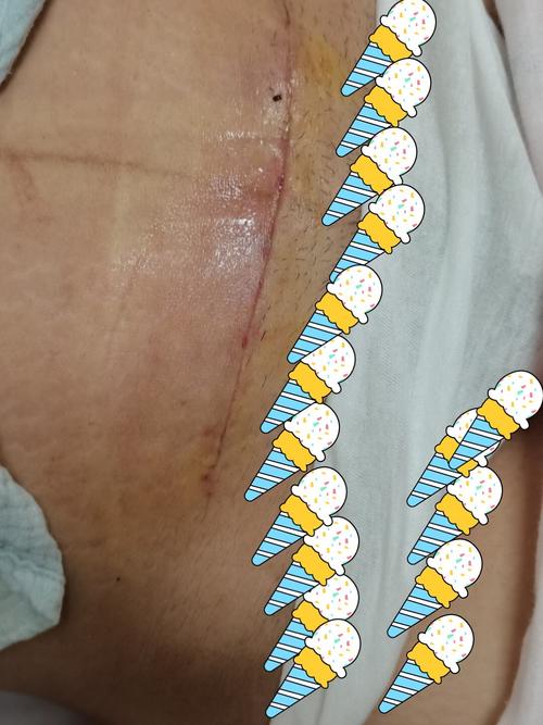 剖腹产刀口_剖腹产_icecream_母婴_妈妈经验