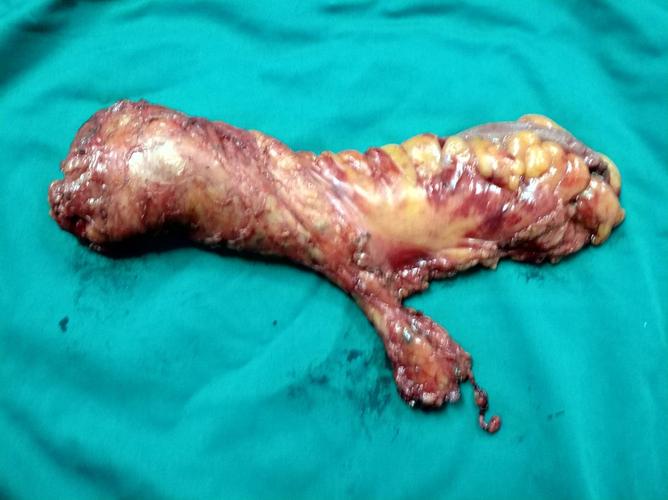 写美篇  术后病理:直肠溃疡型中分化腺癌,浸达浆膜,肿瘤大小5cm*3