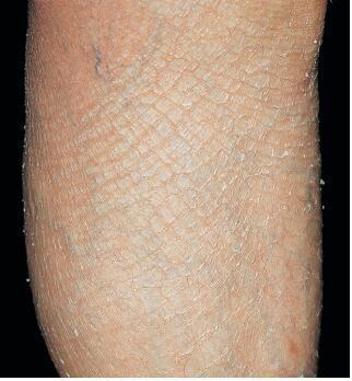 湿疹(特应性皮炎)是怎样发生的呢?