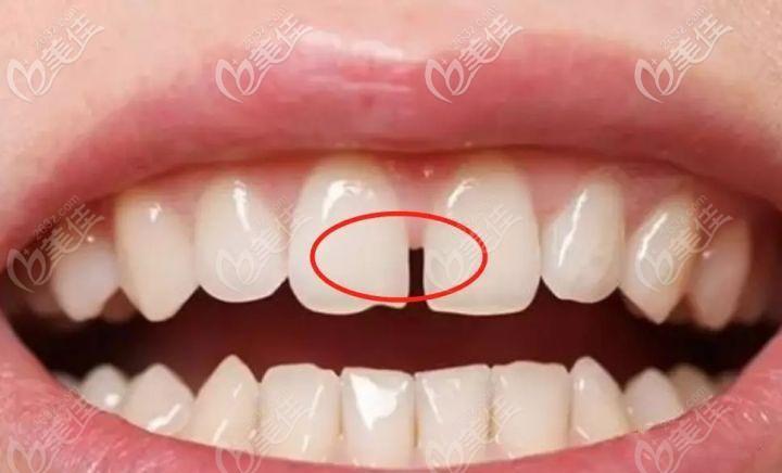 我30岁做了满口固定烤瓷牙,戴了十年的烤瓷牙拆了突然