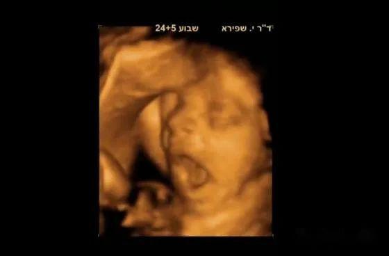 接下来我们一起去看看彩超筛查过程,胎宝宝一些神奇而调皮的举动: 打