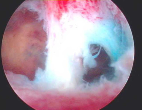 iua)是由于宫腔手术(如刮宫),炎症而形成的子宫内膜形态及功能变化