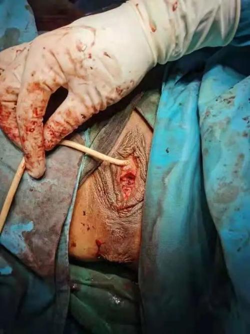 祝65岁阴道前后壁脱垂患者术后顺利出院南阳医专一附院妇科