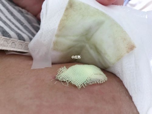 我的乳腺炎化脓开刀手术经历…(上)_乳腺炎_堵奶_夏天