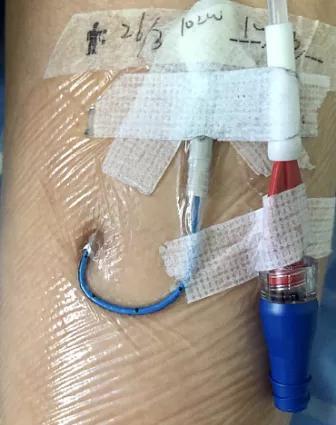 用于为病人提供中,长期的静脉输液治疗或刺激性药物治疗(如化疗