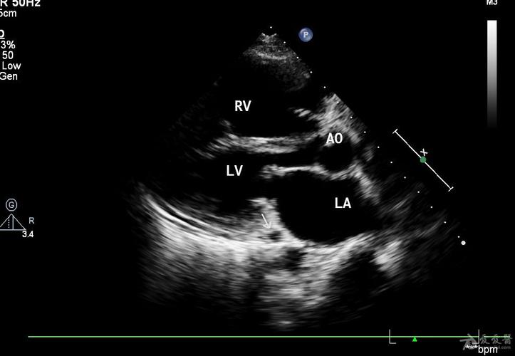 请问:是否是冠状静脉窦型房间隔缺损?