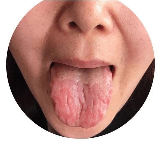 脾胃不好舌头先知道舌头上裂纹越深湿气越重中医教你1招