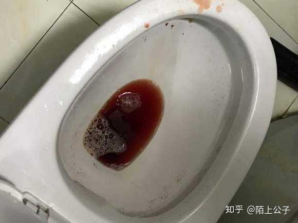 引起肉眼血尿出现的原因除了结石还有这些