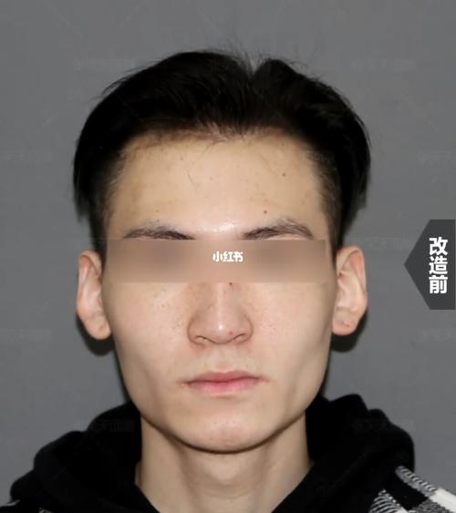 张笑天磨骨,颧骨 下颌骨术后对比_颧骨_磨骨_张笑天_美妆_医美整形