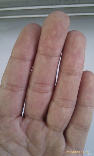 手掌异样,红白斑.