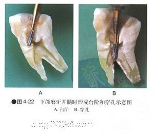 一,根管治疗第一步开髓看起来简单,却经常出现一些小问题,像侧穿和