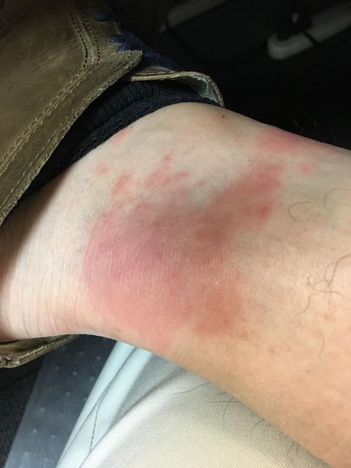 脚踝这里肿起来了,请问这是湿疹还是被跳蚤咬了, 如图