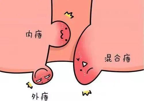 治疗痔疮的最佳方法,你一定要知道!