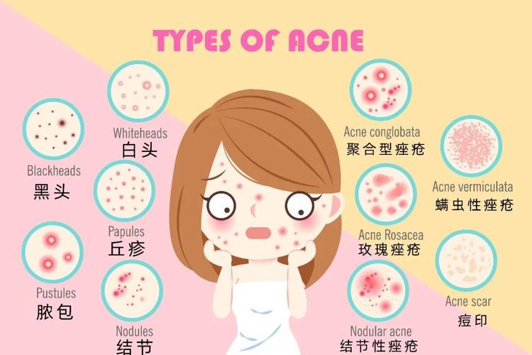 为什么痘痘会反复长如何祛痘