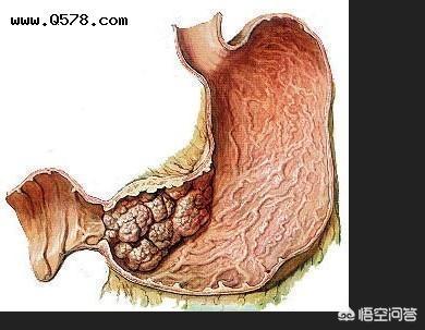 胃癌低分化腺癌存活率多久?手术后有复发,转移风险吗?