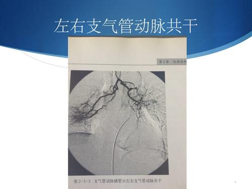 支气管动脉的解剖及病变ppt课件