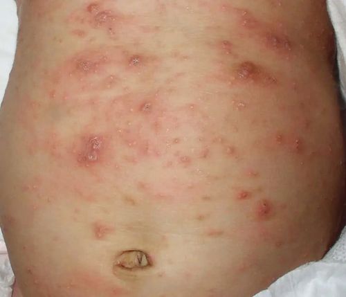 丘疹,皮肤病,湿疹,水疱,皮炎,皮肤,儿童期,单纯疱疹病毒,婴幼儿,寄生